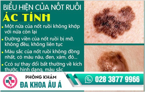 địa chỉ phá nốt ruồi