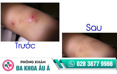 Tiểu phẫu mụn nhọt bằng công nghệ tiên tiến