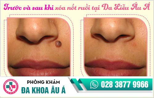 Xóa nốt ruồi bằng laser