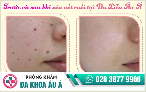 Xóa nốt ruồi bằng laser