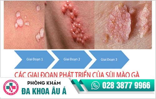 Sùi mào gà nữ