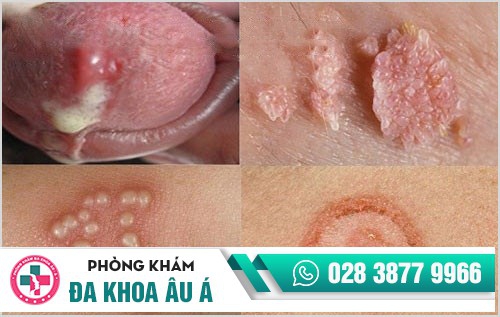 Thống kê từng khoản: Chi phí khám, chữa, xét nghiệm bệnh hoa liễu