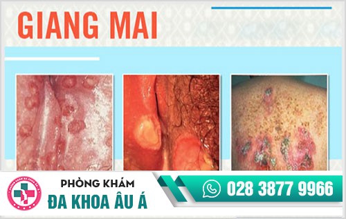 mụn sinh dục là gì