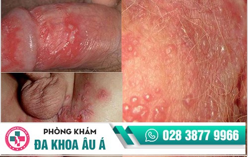 Cách chữa mụn vùng kín và địa chỉ chữa trị uy tín bạn nên biết Cách chữa mụn vùng kín và địa chỉ chữa trị uy tín bạn nên biết