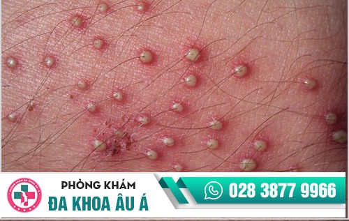 Cách chữa mụn vùng kín Cách chữa mụn vùng kín