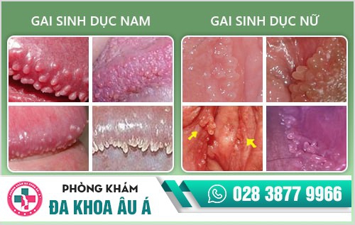 Thuốc chữa gai sinh dục tại nhà được nhiều người dùng