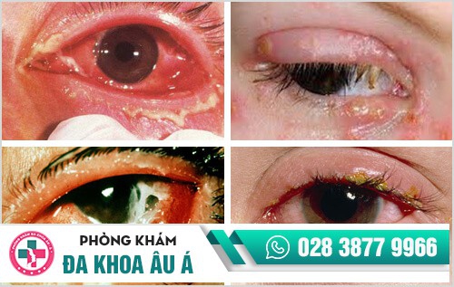 Hình ảnh bệnh lậu mãn tính