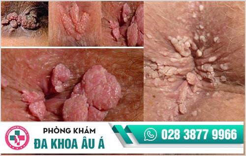 hình ảnh sùi mào gà