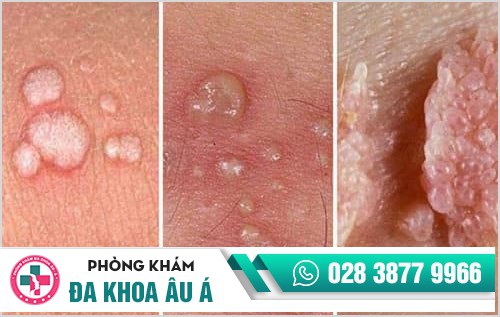 Bệnh hoa liễu là bệnh gì?