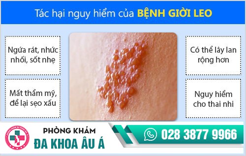 Tất tần tật những kiến thức về bệnh giời leo