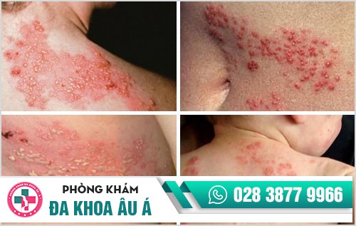 Tất tần tật những kiến thức về bệnh giời leo