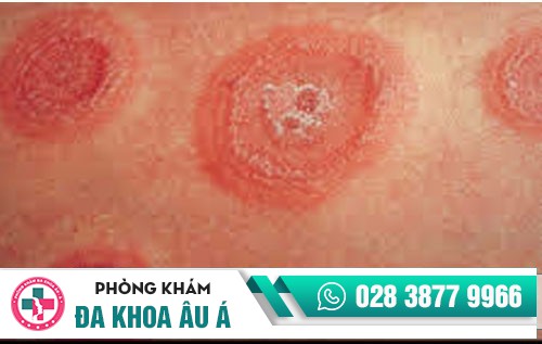 Chữa lác đồng tiền như thế nào hiệu quả, an toàn