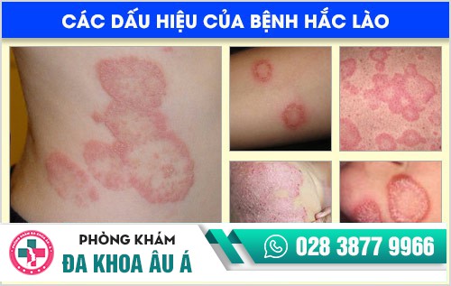 dấu hiệu bệnh hắc lào
