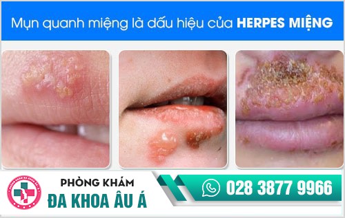 Nổi mụn quanh miệng