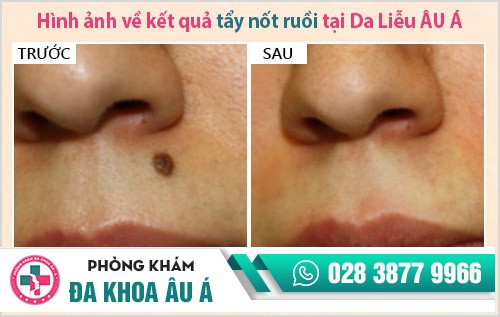 địa chỉ phá nốt ruồi