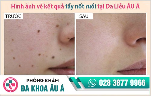 địa chỉ phá nốt ruồi