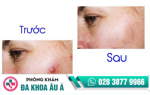 Tiểu phẫu mụn nhọt bằng công nghệ tiên tiến